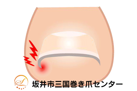 巻き爪矯正の図解