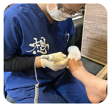 巻き爪の矯正風景